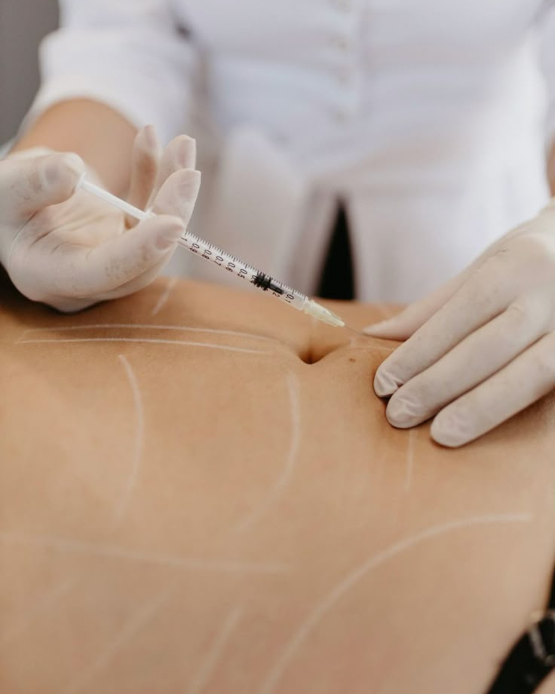 Mesoterapia corporal 5 sesiones