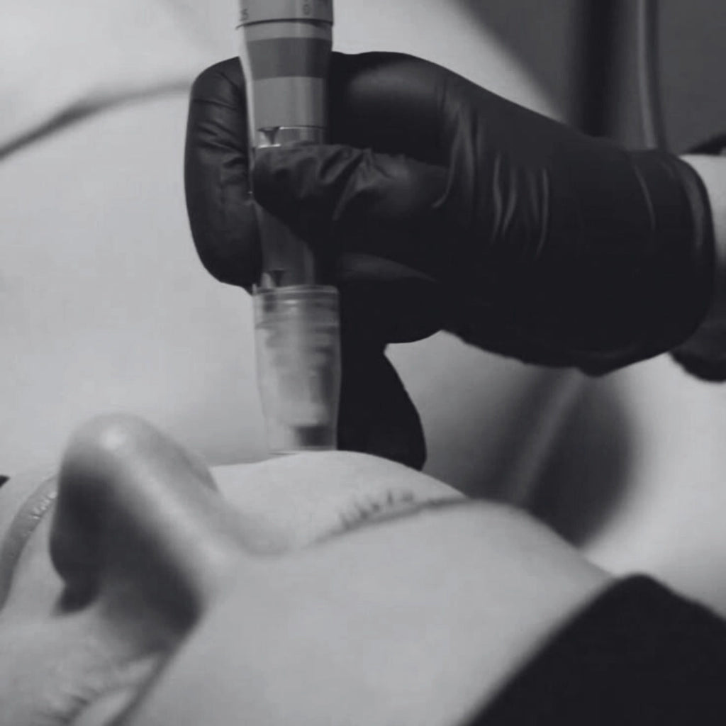 Dermapen facial