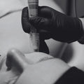Dermapen facial