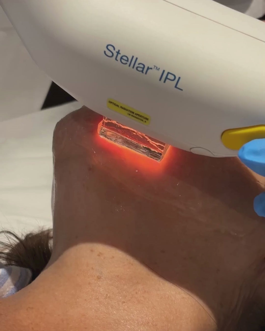Tratamiento Anti Imperfecciones con IPL